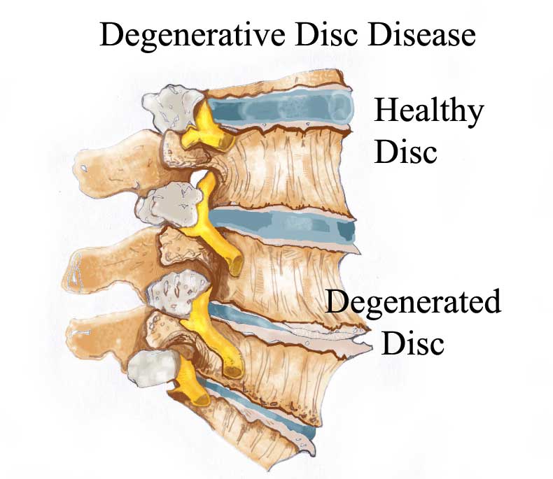 Degeneratiive-disc-disease-790x645