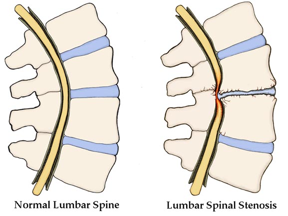 Lumbar-Spinal-Stenosis-good-bad 577x443