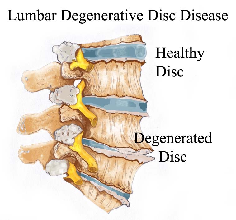 Degenerative Disc Disease 