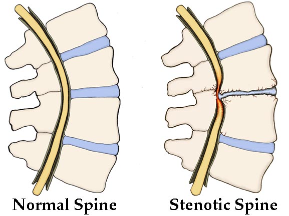 Spinal-Stenosis-good-bad 577x433